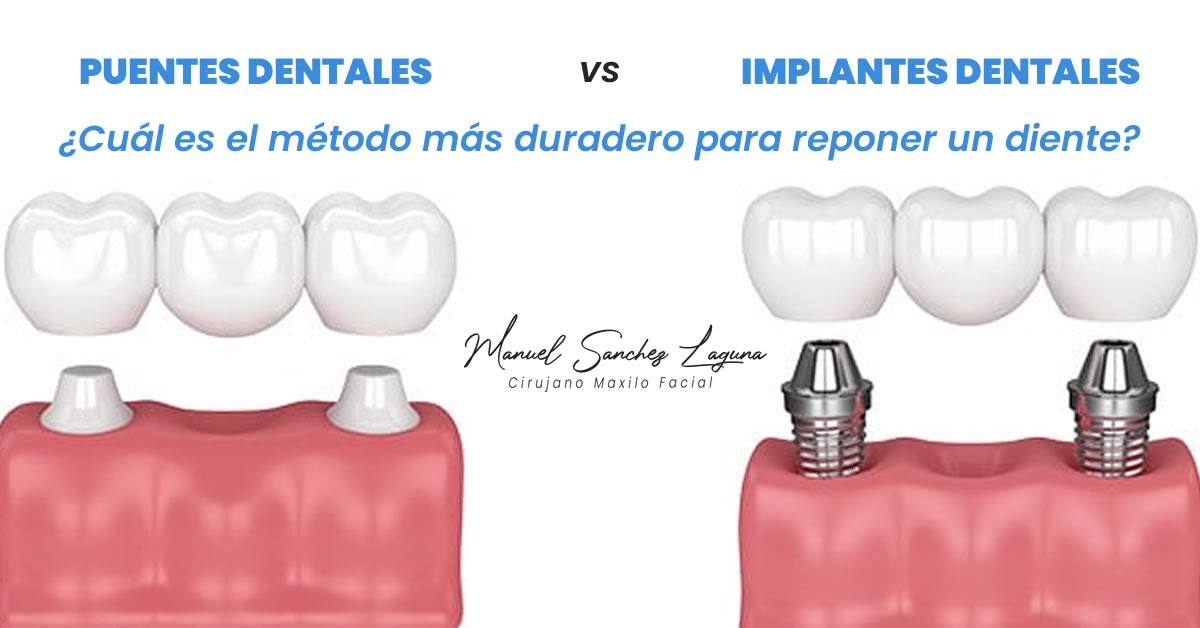 👉 Implantes dentales vs. puentes: ¿Cuál es el método más duradero para reponer un diente?